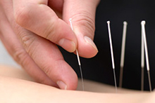 acupuncture needling intramuscular biomedical physiotherapy